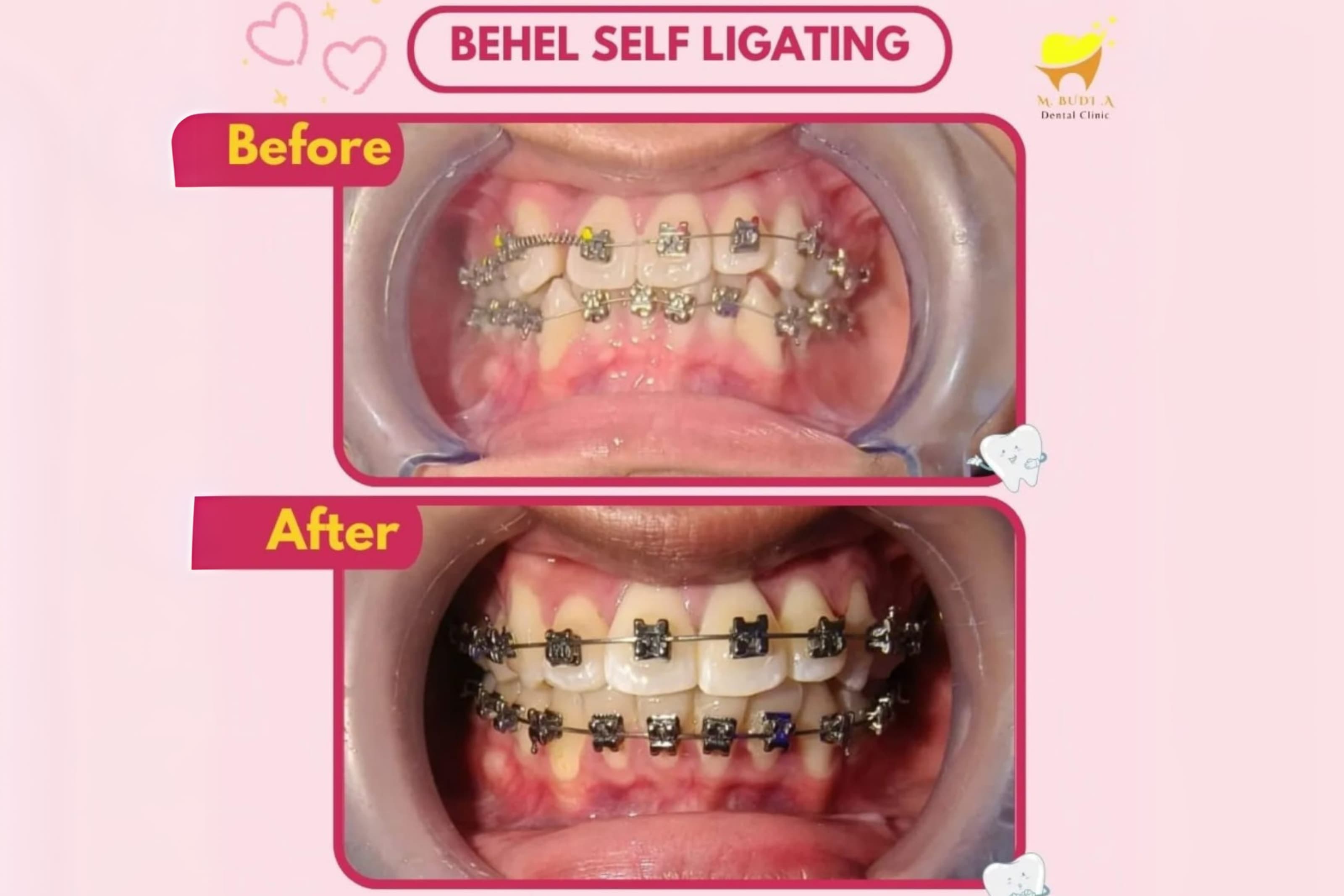 Before After Behel